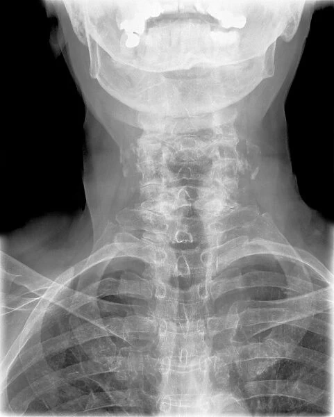 Arthritis of the neck, X-ray C017  /  7389