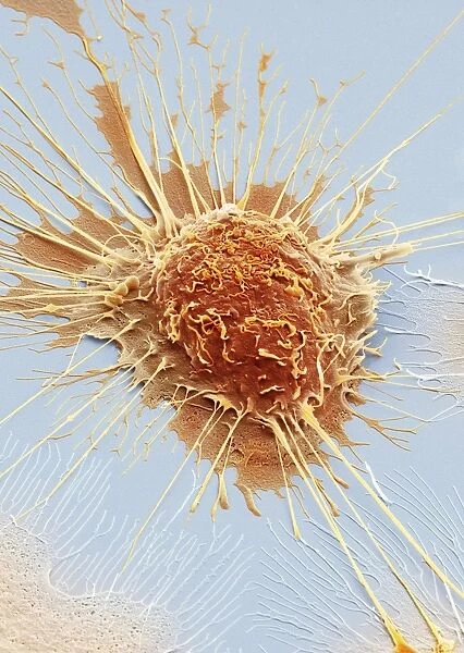 Mouth cancer cell, SEM