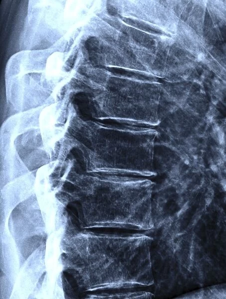 Osteoarthritis of the thoracic spine C017  /  0697