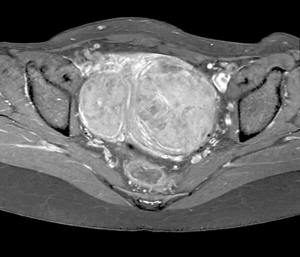 Uterine fibroids, MRI scan C018  /  0466