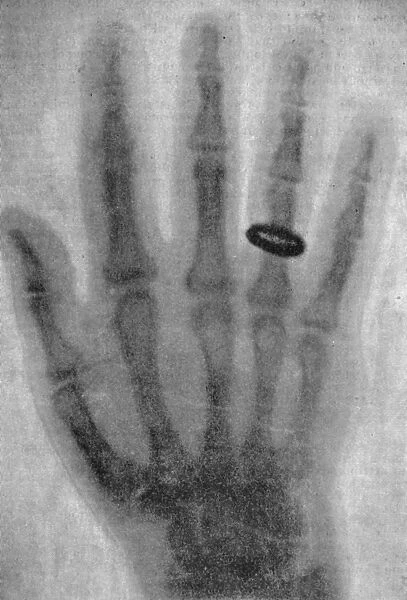 ROENTGEN X-RAY, 1896. The first published X-ray photograph, as reproduced in Wilhelm
