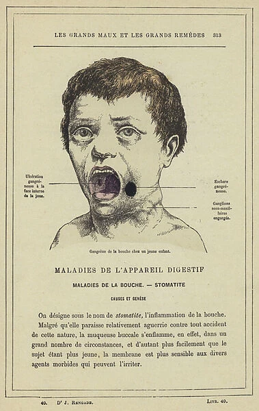 Gangrene de la bouche chez un jeune enfant (colour litho)
