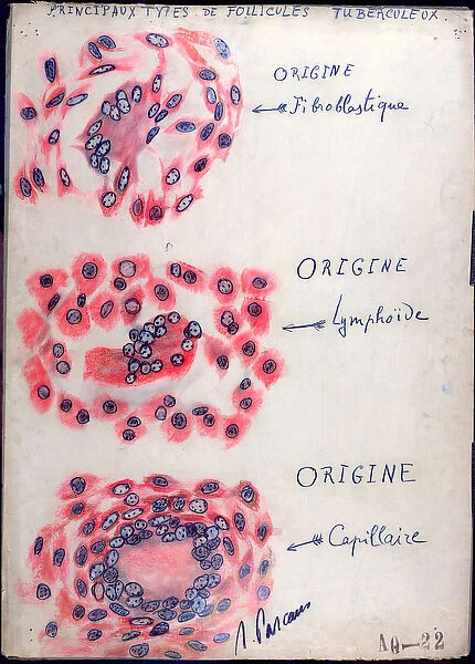 Principle tuberculosis follicles (pen & ink on paper)