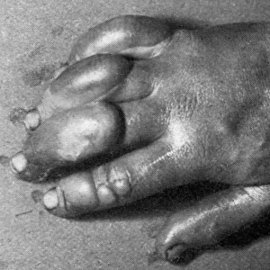 Frostbitten hand of Edward Atkinson, Antarctic expedition 19