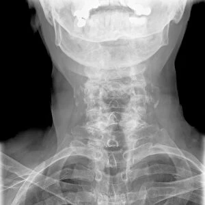 Arthritis of the neck, X-ray C017 / 7389