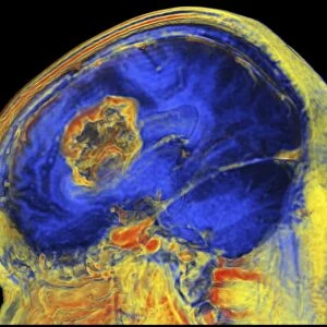 Brain tumour, 3-D MRI scan