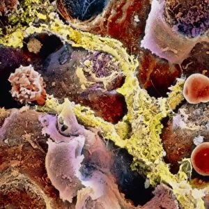 Coloured SEM of liver tissue with fibrosis