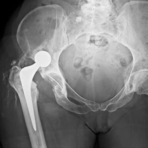 Dislocated hip replacement, X-ray C017 / 7803