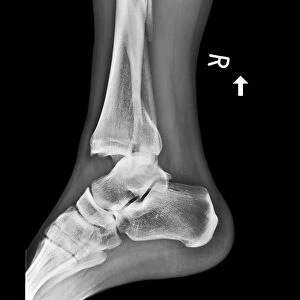 Fractured and dislocated ankle, X-ray C017 / 7976