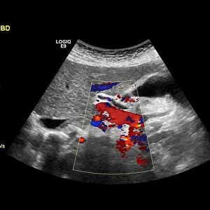 Gallstones, ultrasound scan C017 / 7781