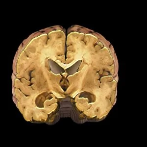Healthy brain, MRI scan C018 / 0423