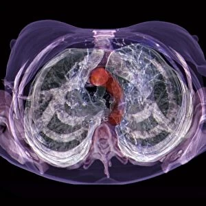 Healthy lungs, 3D CT scan C016 / 6503