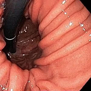 Hiatal hernia, endoscopic view C016 / 8330