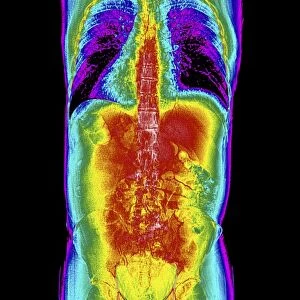 Human torso, coloured mri scan C014 / 2644