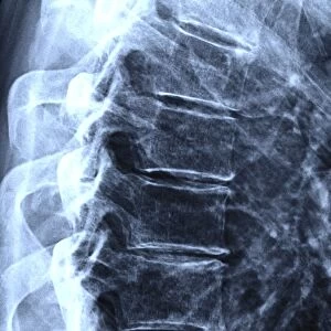 Osteoarthritis of the thoracic spine C017 / 0697
