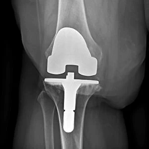 Prosthetic knee and obesity, X-ray C016 / 6593