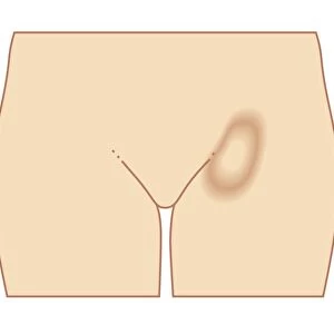 Biomedical illustration of femoral hernia in female