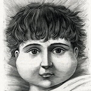 Child with mumps disease (engraving) 1888