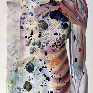 Tumours and cancerous tubercles, from Anatomie Pathologique du Corps Humain