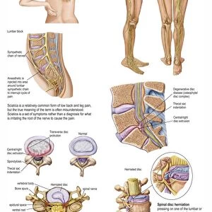 Medical chart showing the signs and symptoms of sciatica